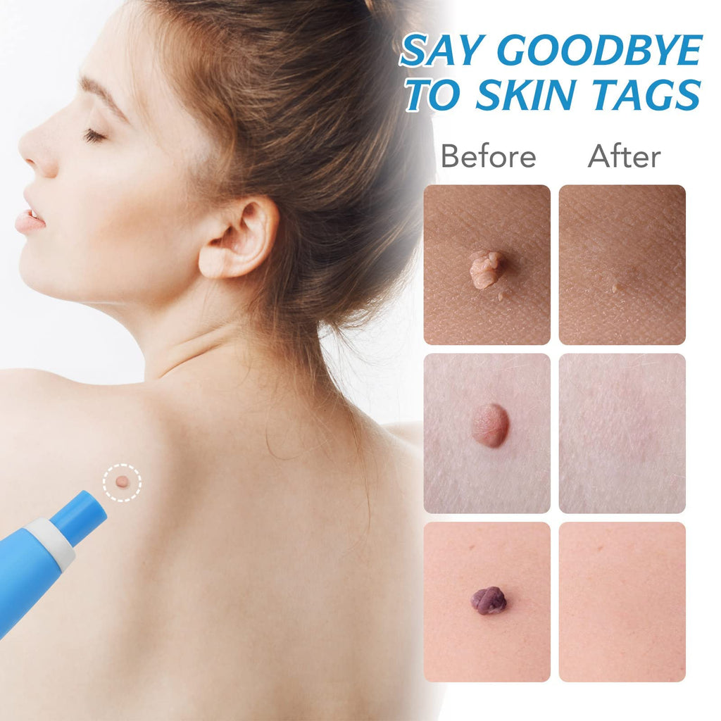 Auto Skin Tag Remover Kit for Face & Body