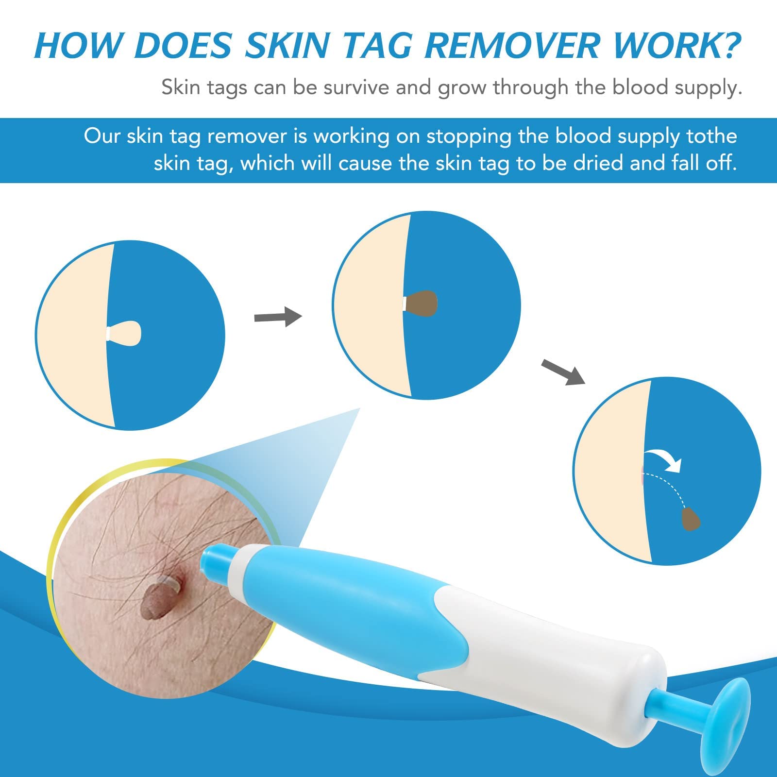 Auto Skin Tag Remover Kit for Face & Body